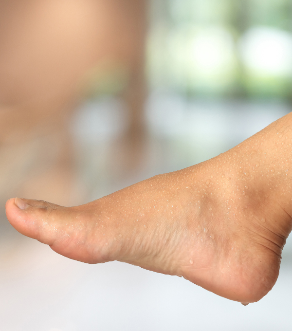 How to treat excessive foot perspiration?